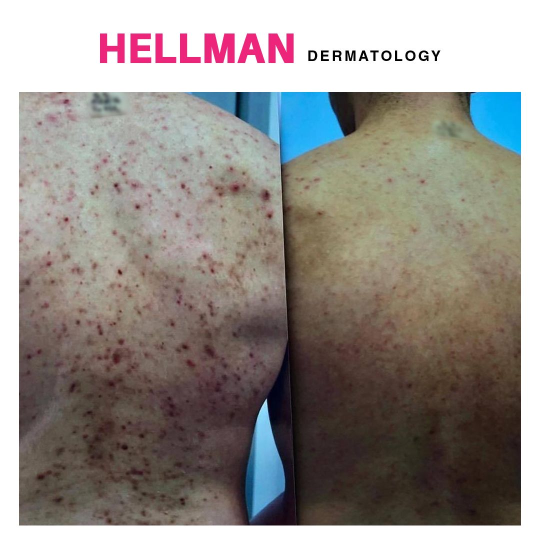 Dr. Hellman uses PDL (Pulse Dye Laser) to treat red acne lesions. After 6 treatments, our patient was delighted with his results.
#backacne #acnetreatment #acnelaser #acneremoval #acnebeforeandafter #cosmetictreatments #dermatologistnyc #nycderm #nycdermatologist