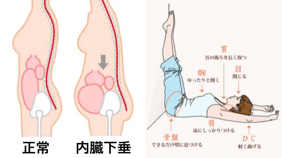内臓下垂