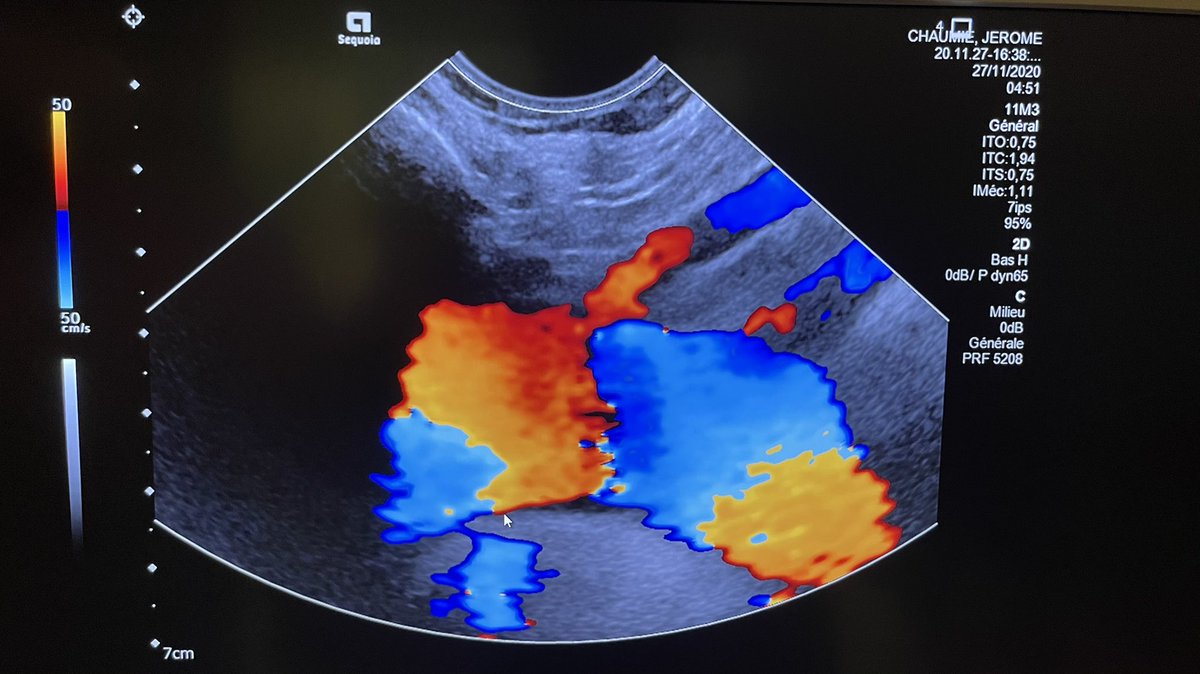 wassimokaddem's tweet photo. Visualisation de la crosse de l’#Aorte par #EchoDoppler par voie sus-sternale... rendu possible par la miniaturisation des sondes microconvexes ! #siemensheathineers @alebura @Echoraljpangio @afintmedvasc @EPLVaisseaux @CHUdeToulouse https://t.co/KZq4TQjkPX
