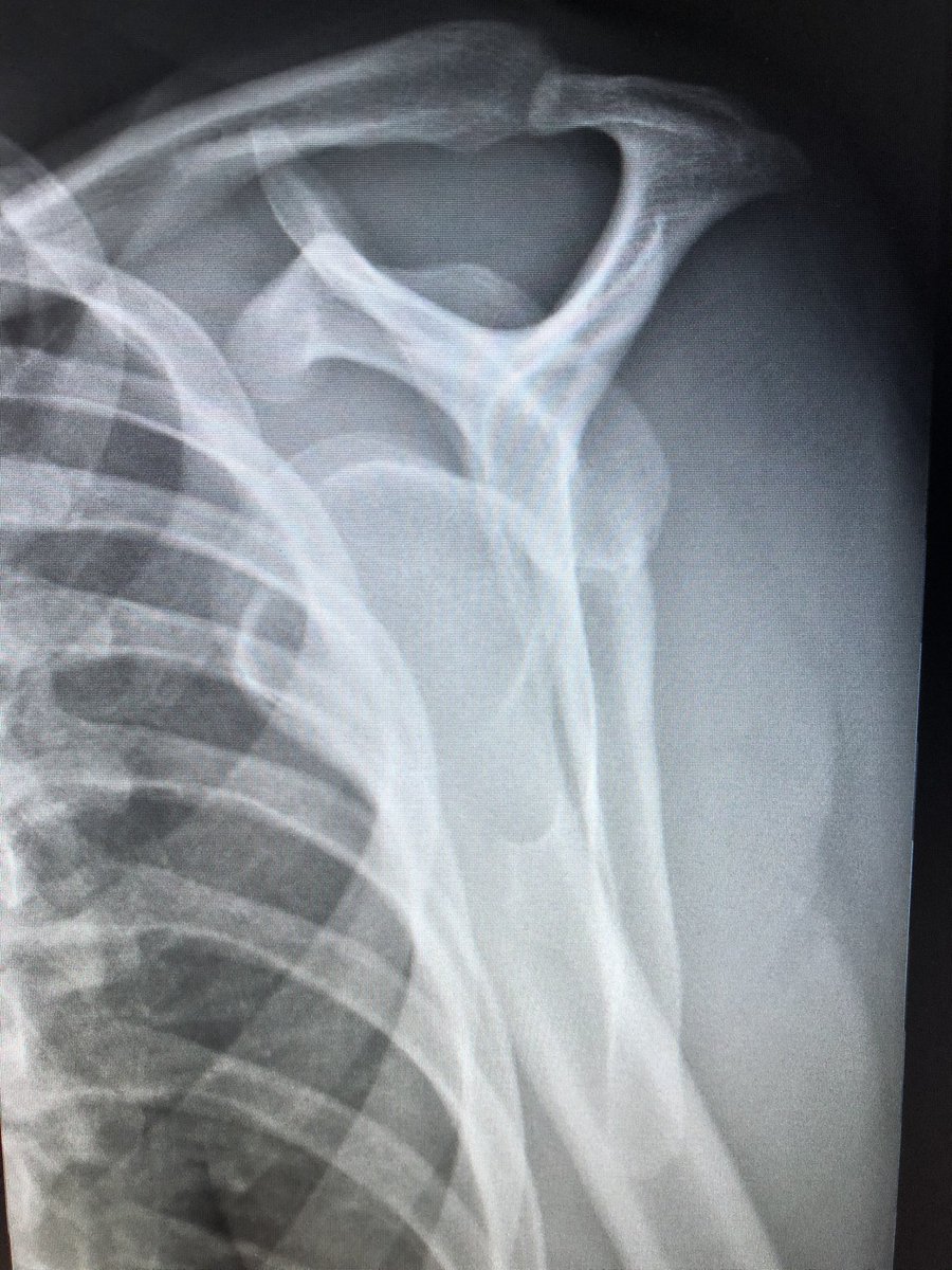RadiologyHumor's tweet photo. A little Thanksgiving dislocation, anyone?! https://t.co/uGaLBSF7Ox