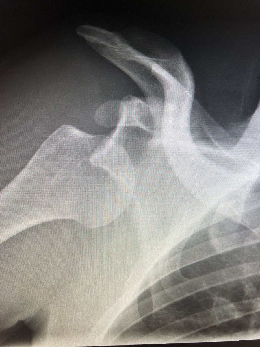 RadiologyHumor's tweet photo. A little Thanksgiving dislocation, anyone?! https://t.co/uGaLBSF7Ox