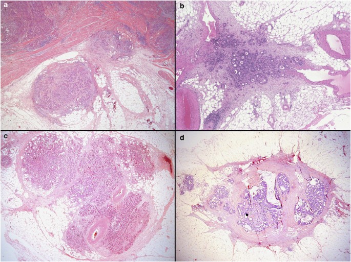 ColorectalDis's tweet photo. N1c colon cancer and the use of adjuvant chemotherapy: a current audit of the National Cancer Database https://t.co/NcOnUJXVL5 https://t.co/uzq1dPZmlo