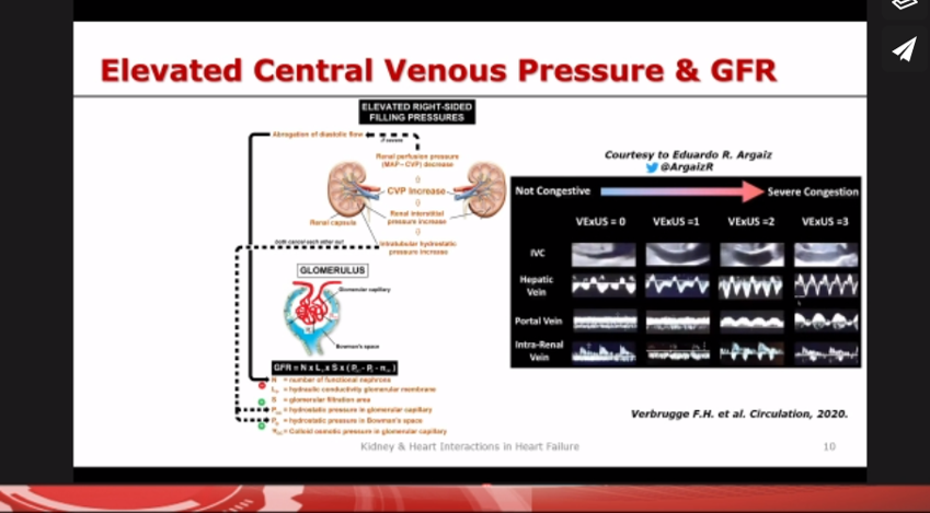 CpaolaParedes's tweet photo. Kindey and Heart interactions in HF #SICA2020 🇲🇽@FH_Verbrugge
👉There is an increased nephron loss in the life course of HF patients
👉⬇️Renal blood flow (RBF=MAP-CVP) is caused by low CO or high CVP.
👉⬇️RBF⬆️ Filtration fraction (FF=GFR/RBF) and ⬆️Intraglomerular pressure https://t.co/16kGsYYgrv
