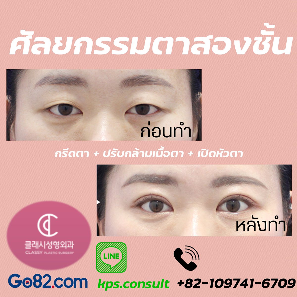 Go82Th's tweet image. เสริมตาสองชั้น👁
การศัลยกรรมเสริมตาสองชั้น จะทำให้ตาของคุณดูเป็นมิติมากขึ้น❗❗ 
ใครสนใจอยากปรึกษาเรื่องศัลยกรรม
เข้ามาสอบถามกับเราได้เลยค่ะ  
😀😀😀😀
#ศัลยกรรม #ศัลยกรรมเกาหลี #เสริมตา #ตาโต #ปรึกษา #เกาหลี #รีวิวศัลยกรรม #รีวิว   #คนเกาหลี #ความสวย #คนไทยในต่างแดน #สไตล์เกาหลี