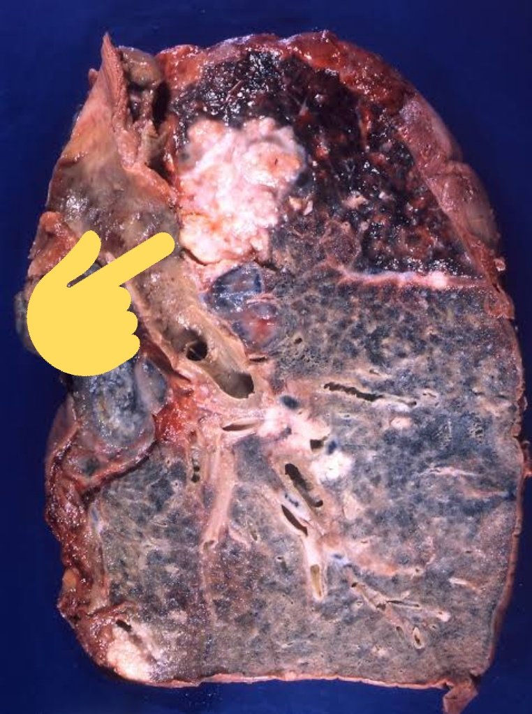 Kanker paru adalah salah satu penyebab utama kematian akibat kanker. 

Faktor risiko utamanya adalah kebiasaan merokok dan polusi udara.