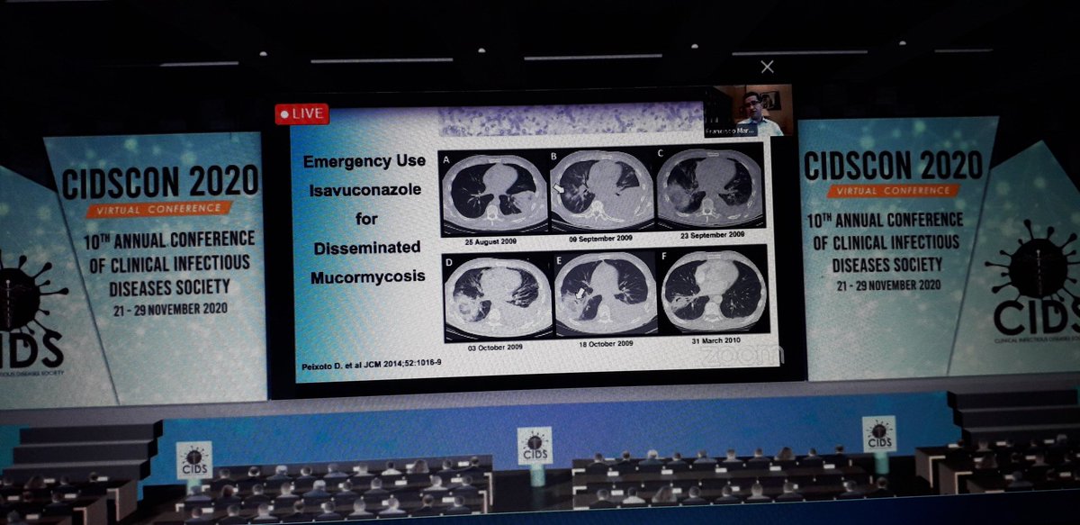 KavithaSaravu's tweet photo. Enriching talk on newer antifungals and nuances of treatment of #mucormycosis by none other than @FranciscoMarty_ at #CIDSCON2020 @CidsIndia https://t.co/JQEk09gJej