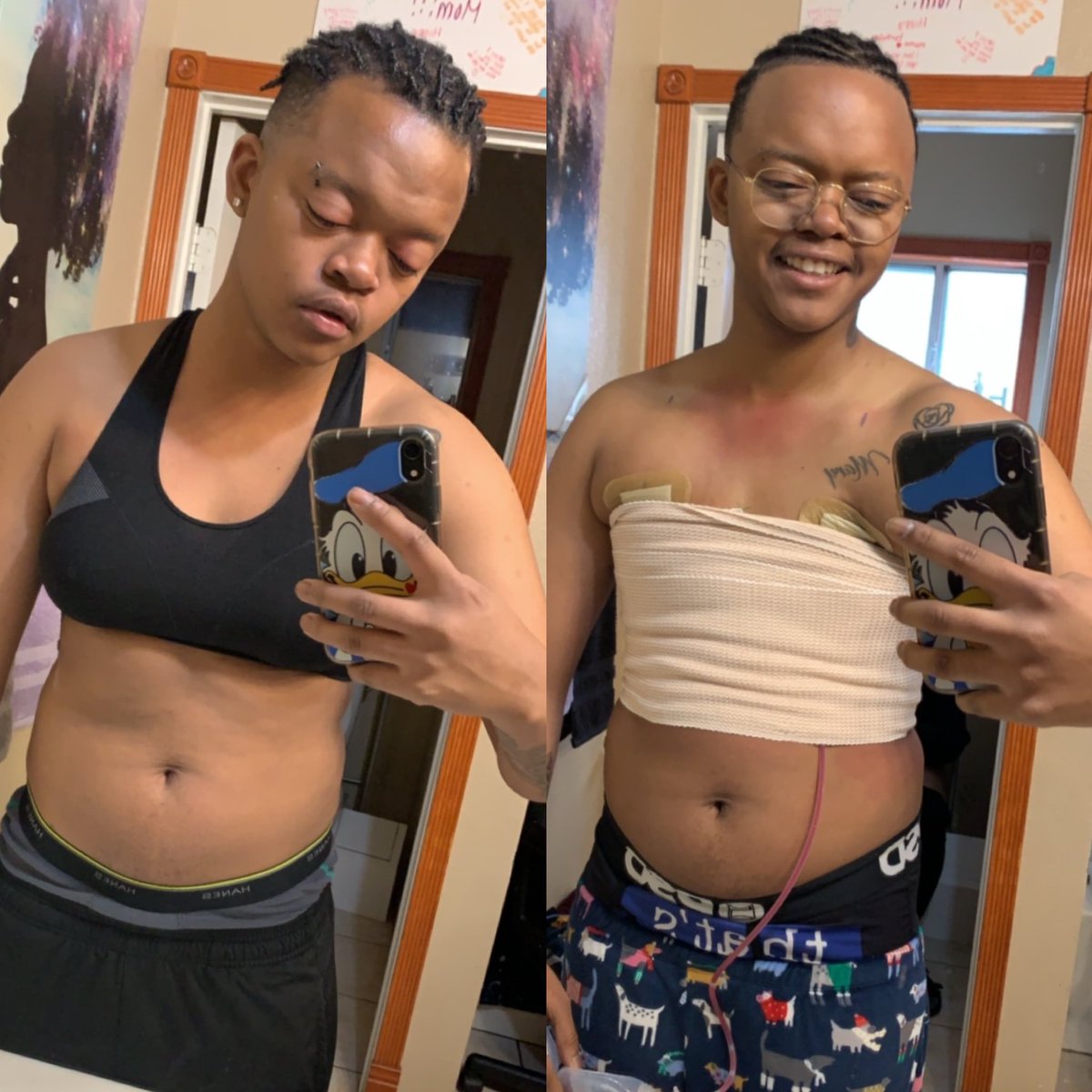 alien_naytee's tweet photo. Soooooo I had my Top Surgery and I’m TOO HAPPY!!!!!!!!!! #ftm #transmanofcolor https://t.co/F4bViH9HHa