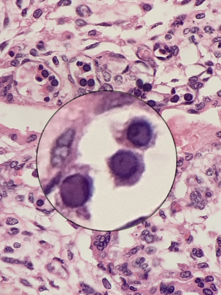 Janiranavarro's tweet photo. Fetal Parvovirus infection 
Placenta
✅ Glassy intranuclear inclusions in fetal nucleated red blood cells 
Dr. Thompson slide box 📦 
#pathology #pedipath #pathologyresidency #pembefy #parvovirus https://t.co/TWwJrCIRcA