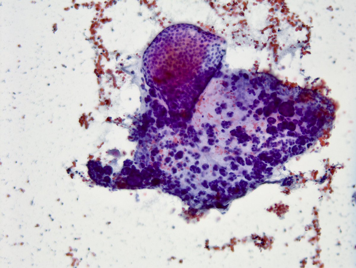 sza_jhcyto's tweet photo. IMPORTANT Teaching Point - It’s NOT uncommon to have focal microfollicular (MF) proliferation (image#1) with rare colloid in “Benign” Thyroid FNAs. This “Adenomatoid Nodule” on another pass clearly shows macrofollicles. I look for at least 50% MFs for FN/SFN diagnosis. https://t.co/6mebcFtn2c
