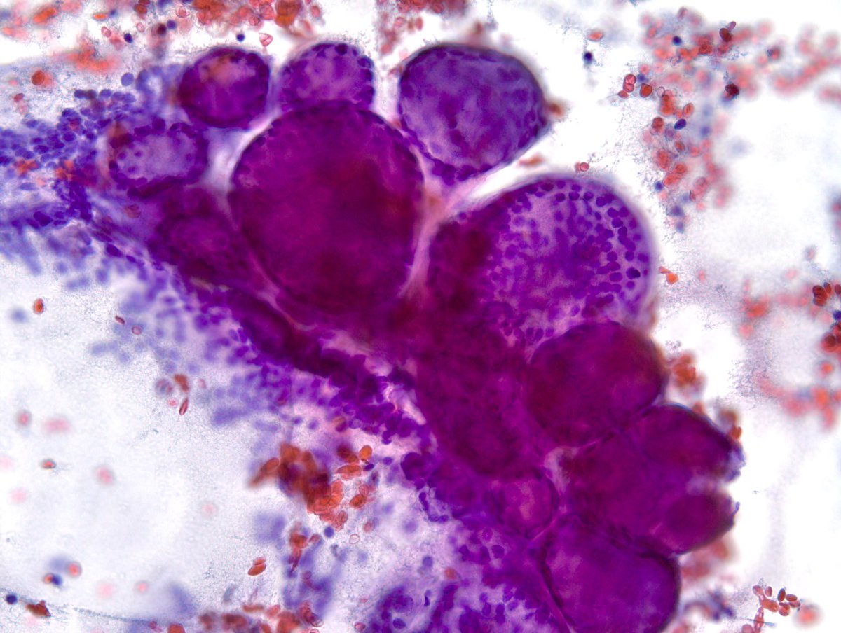IMPORTANT Teaching Point - It’s NOT uncommon to have focal microfollicular (MF) proliferation (image#1) with rare colloid in “Benign” Thyroid FNAs. This “Adenomatoid Nodule” on another pass clearly shows macrofollicles. I look for at least 50% MFs for FN/SFN diagnosis.