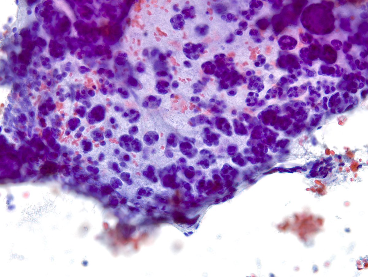 sza_jhcyto's tweet photo. IMPORTANT Teaching Point - It’s NOT uncommon to have focal microfollicular (MF) proliferation (image#1) with rare colloid in “Benign” Thyroid FNAs. This “Adenomatoid Nodule” on another pass clearly shows macrofollicles. I look for at least 50% MFs for FN/SFN diagnosis. https://t.co/6mebcFtn2c