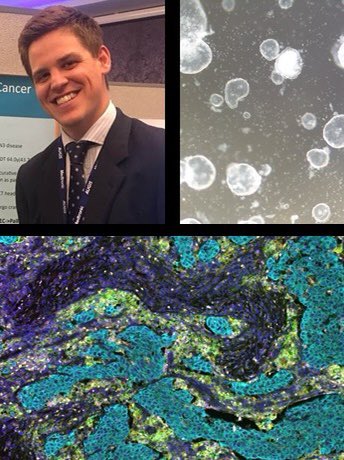 nima_ghadi's tweet photo. Congratulations to our registrar @charles_rayner who was awarded @The_MRC Fellowship this week to support his PhD investigating new immunotherapies for oesophageal cancer @RoyalSurrey @UniOfSurrey @ISDE_net @AUGISt_UK @Pritam__Singh #CancerResearch #oesophagealcancer #OGsurgery https://t.co/GASL2m3pnj