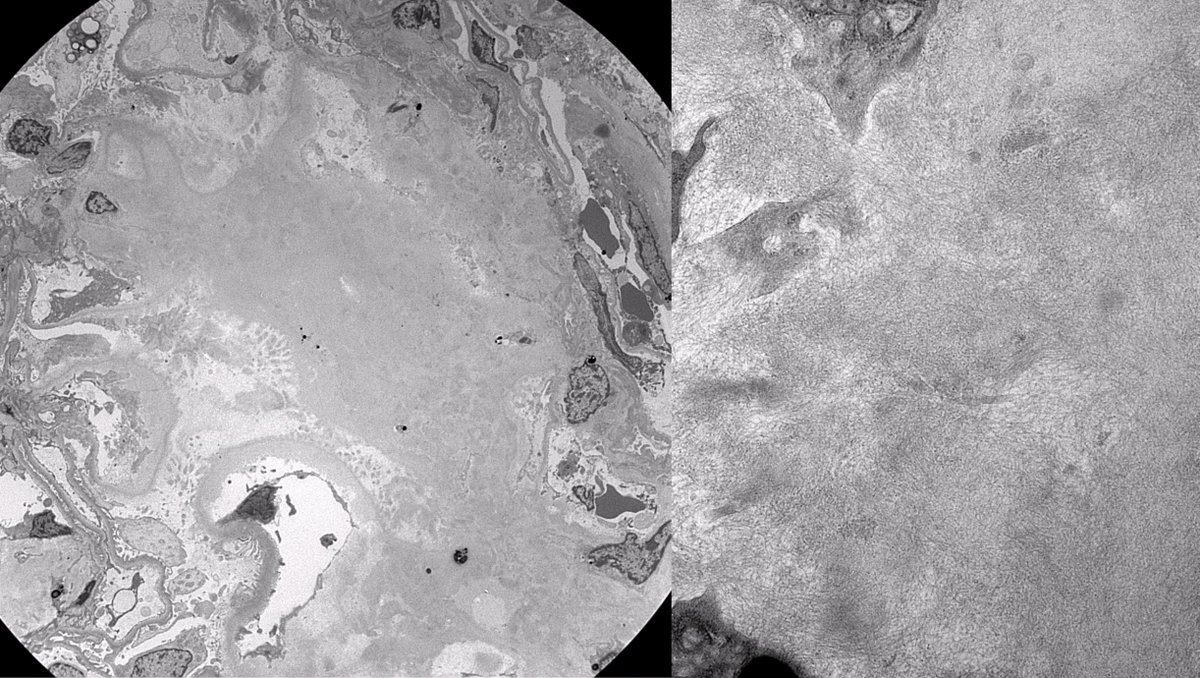 JZRenalPath's tweet photo. Patient with seronegative spondyloarthropathy with new onset nephrotic syndrome and hematuria. Renal bx demonstrates AA amyloidosis. Often seen in the setting of chronic inflammatory conditions.  #renalpath https://t.co/qOjbAMfLFU
