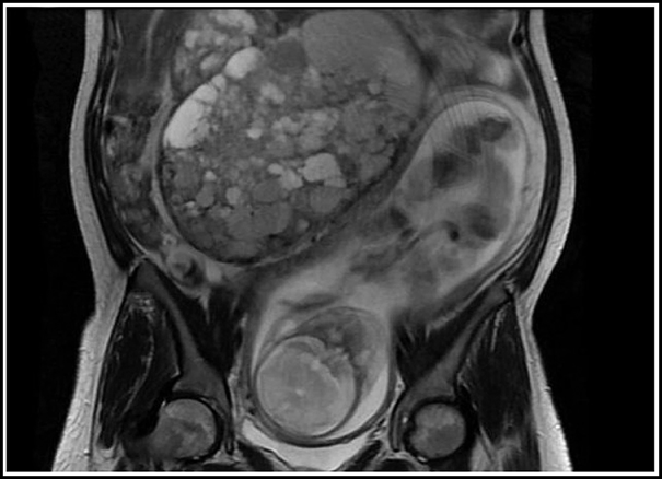 TimKorevaar's tweet photo. Just read the outstanding study by Irina Bancos et al on:
Pheochromocytomas in pregnancy
A thread!
Based on my fascination for pheochromocytomas, obstetric medicine and these new data.
pic=malignant paraganglioma+fetus https://t.co/ZLsoag3xE3
paper: https://t.co/PAccrm3i6j https://t.co/lyfnkE2CZI