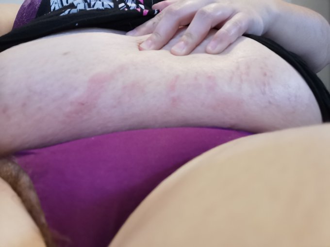 A fat overhang with no airflow and baby oil that doesn't come off easily results in a super itchy rash