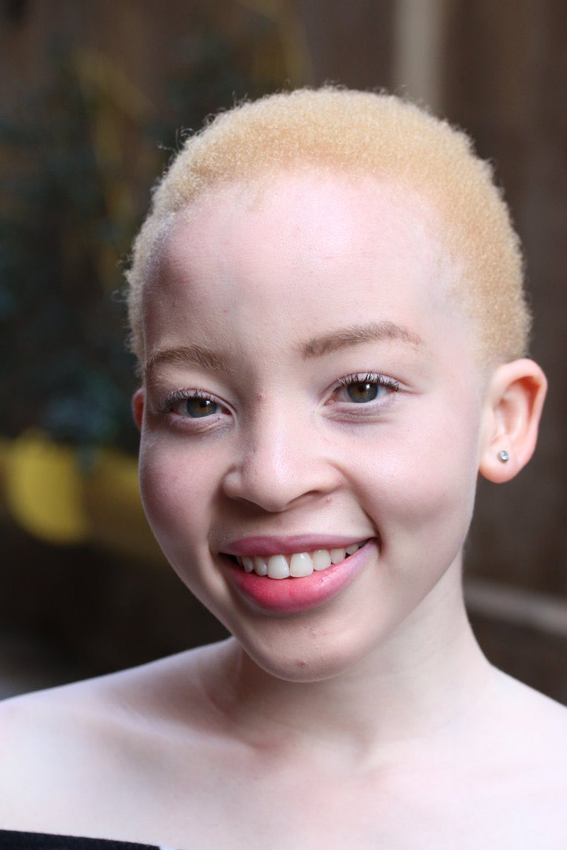 IamMzilikazi's tweet photo. LOVE and RESPECT: Albinism isn’t a curse but a genetic condition 30 https://t.co/yVsNlKGuuP