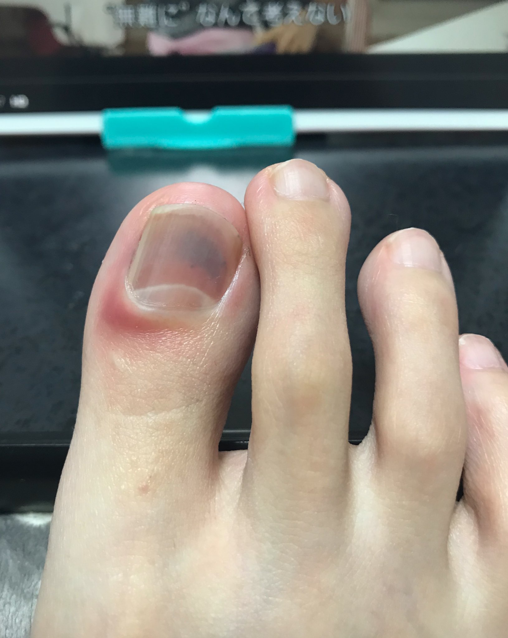 秋夜 ヒール履いたら親指の爪っ どんどん青くなる 本当ヒール嫌い ヒール日常的に履いてる女の人凄すぎる T Co U9hzoff3oa Twitter