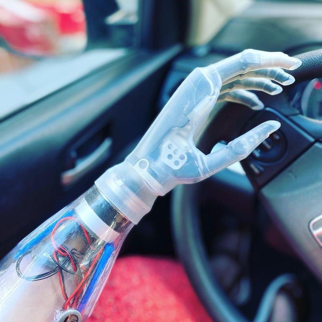 WCBL_OandP's tweet image. We‘re loving our patient Carla’s new style choice! 🦾👀❤️👉💬“My girl got a new look today. Clear glove it is! Love it!” #upperextremityprosthesis #prostheticarm #amputeestyle #limbdifferenceawareness #ossur