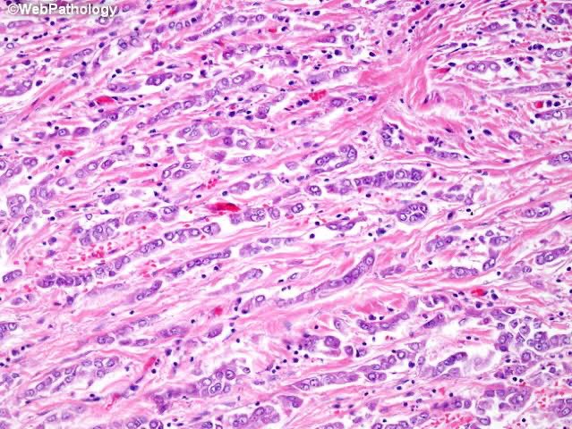 DrVaanya's tweet photo. China’s first confirmed Covid-19 case traced back to November 17, 2019, exactly a year back.

On that note, as mentioned by Dr. RF Chinoy, the tumour cells in ILC  breast look as if they’re maintaining social distancing 😃😋

#ILC #BreastPath #IndianFile https://t.co/oMrdOEPANB