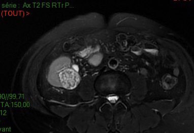UrologieParis's tweet photo. Robotic partial nephrectomy on a kidney allograft for a posterior mass:
📌plan your procedure ( anatomy of transplant vessels)
🤖Don t hesitate to change camera arm (DaVinci Xi)
⏱Maximal off-clamp enucleation before clamping to lower WIT 
(If untrained: go open) @TheoToinet https://t.co/9ZxKYd0Zcm