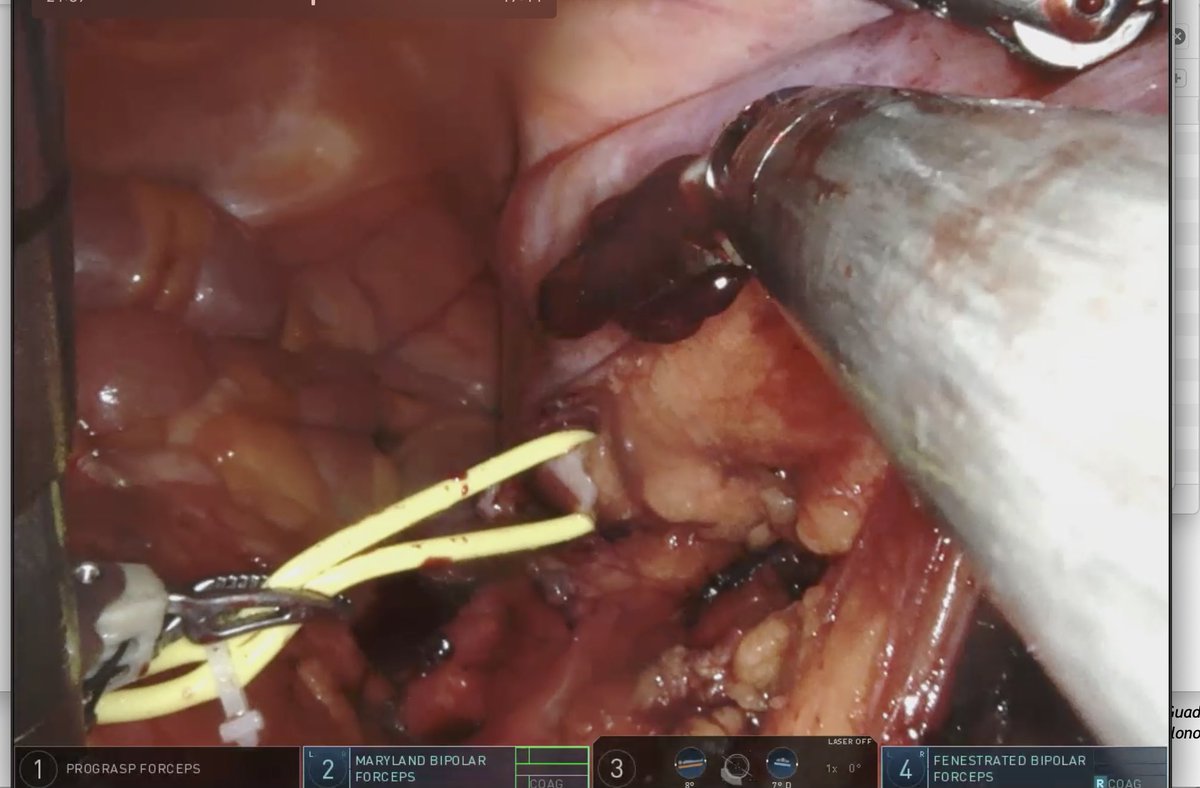UrologieParis's tweet photo. Robotic partial nephrectomy on a kidney allograft for a posterior mass:
📌plan your procedure ( anatomy of transplant vessels)
🤖Don t hesitate to change camera arm (DaVinci Xi)
⏱Maximal off-clamp enucleation before clamping to lower WIT 
(If untrained: go open) @TheoToinet https://t.co/9ZxKYd0Zcm