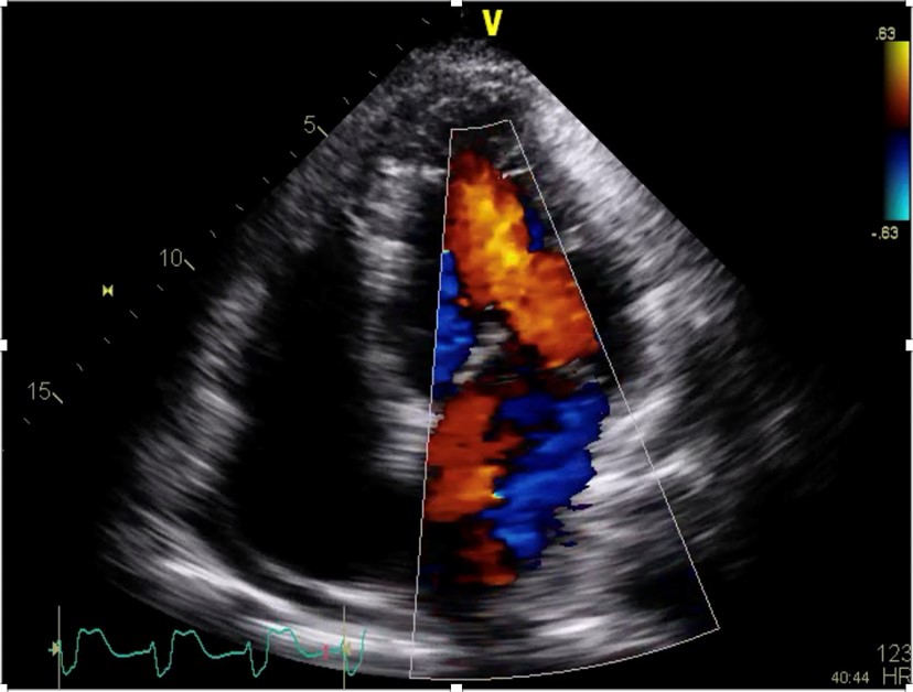 ACEP_EUS's tweet photo. Early recognition of papillary muscle rupture w/ #POCUS can expedite appropriate mgmt & save lives. Here's a great case by Drs. Lindsay Taylor @ultrasound_vcu & Zan Jafry @LomaLindaEM highlighting this! https://t.co/eETUo4YTxS
#POCUSftw #echofirst #FOAMus #FOAMed @ACEPNow https://t.co/C9Rclqq74m
