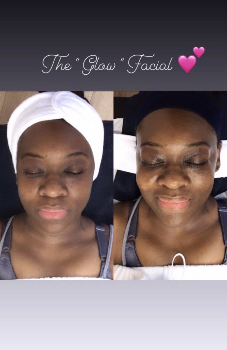 Client Received | The “ G L O W “ facial . Treats Hyperpigmentation &amp; Dark Spots . AND Great for my clients who would like to brighten &amp; even skin tone . 💕 

armaniaesthetics.as.me