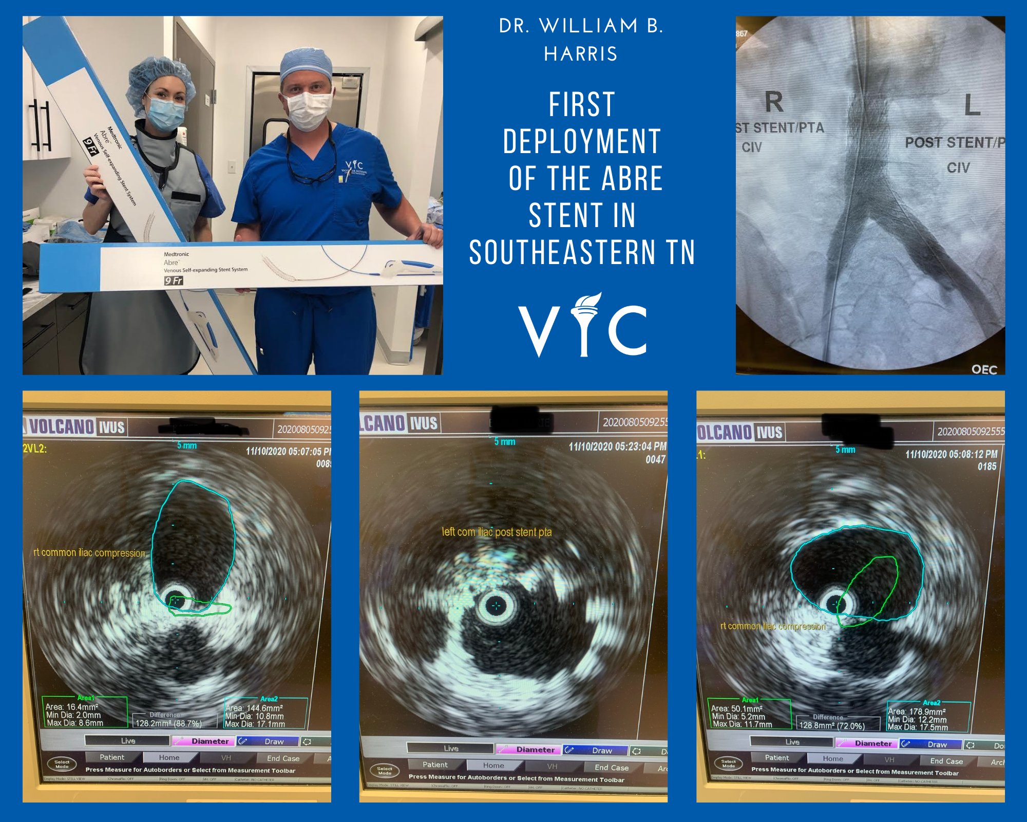 Vascular Institute 45 Yo F With Bilateral Le L R Swelling Hx Of Left Left Leg Dvt Bilateral Iliac Venogram W Philips Ivus Stent Placement W 16x100 On R And 16x1 Medtronic Abre Stent