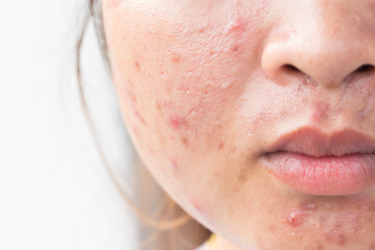physical acne scars