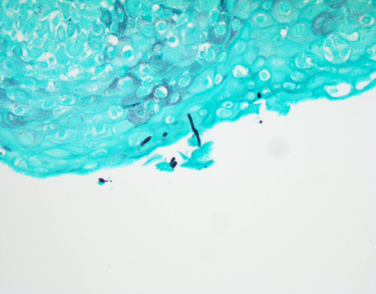 JFH_Path's tweet photo. If confirmation of your suspicion for a fungal esophagitis makes you feel 💯, you know #pathology is the right choice for you. #GIpath https://t.co/jT4S7kfqJm
