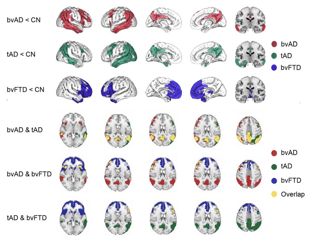 Beat_it_studie's tweet photo. Vers van de pers: onze groep toont patronen van hypometabolisme, connectiviteit, subcorticale atrofie en wittestofschade bij de gedragsvariant van #Alzheimer, een stap dichterbij het begrijpen van de neurobiologie van gedrag bij #Alzheimer @ZonMw @alzheimernl https://t.co/1uqQNcWLon