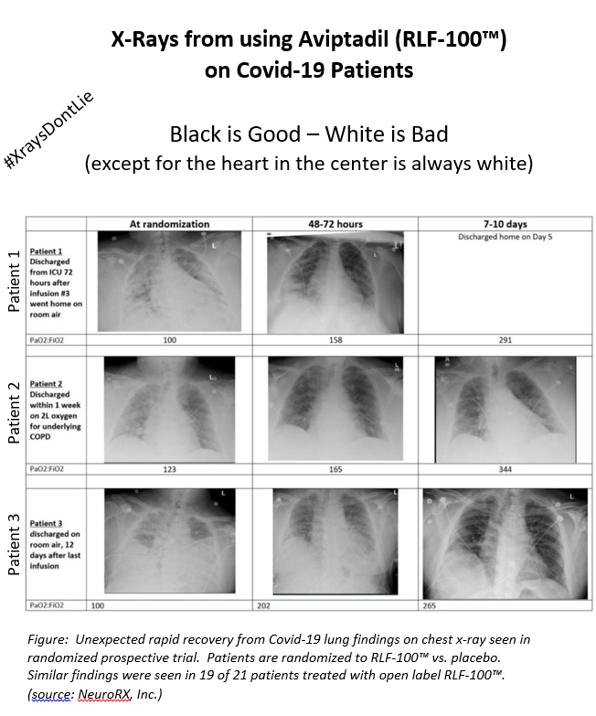 UncleGeeGee's tweet photo. “RLF-100™ outpaces traditional clinical development timelines to meet the necessary requirements to demonstrate safety and efficacy data in the treatment of severely ill COVID-19 patients.”

Dr. Raghuram (Ram) Selvaraju

#AviptadilStopsCovid 

#COVID19 #RLF100 #XraysDontLie https://t.co/p5A5zCAr0t