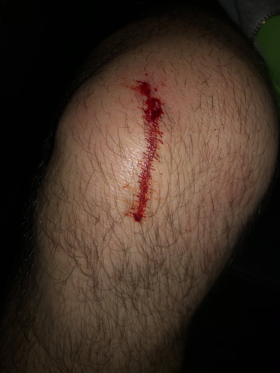 middpeter's tweet image. Well first time falling over while running 🏃🏻‍♂️🤕🥴but at least I completed the run.