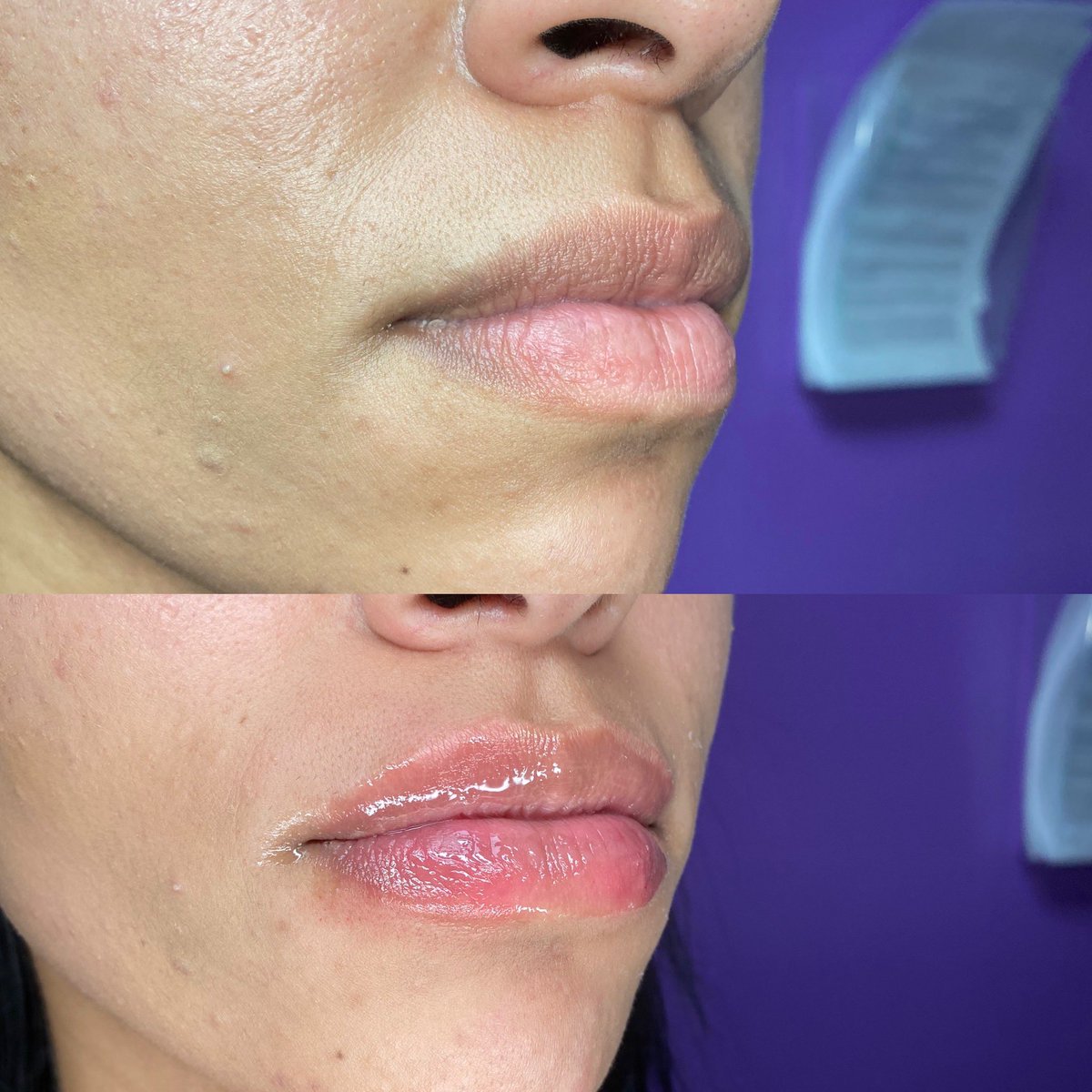 Killlatoro's tweet photo. Lip filler sale! 25% off: Use code “25OFF” 
https://t.co/iLfv5ww6NV https://t.co/hAHUbV3YxH