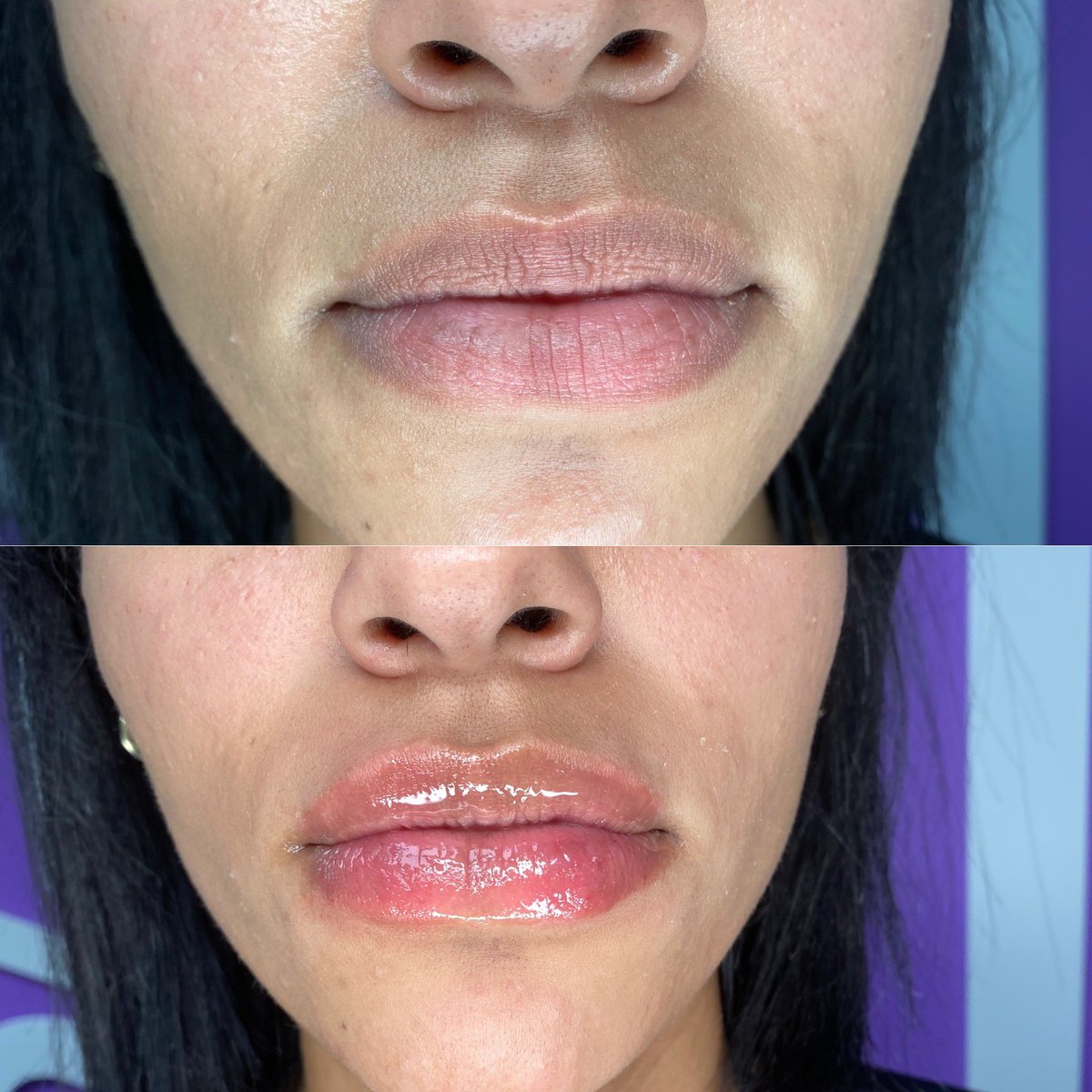 Killlatoro's tweet photo. Lip filler sale! 25% off: Use code “25OFF” 
https://t.co/iLfv5ww6NV https://t.co/hAHUbV3YxH