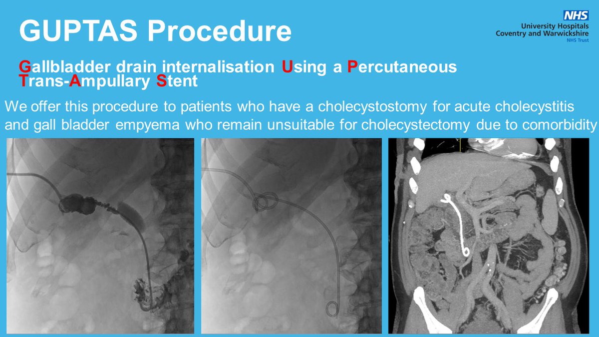 The British Society of Interventional Radiology (@bsir_news) on Twitter photo Wednesdays Classic IR case: We would love to do all PTCs under GA but IR nurse administered sedation is safe & effective in most patients. Also a good segway for <a href="/DrNeilGuptaIR/">Neil Gupta</a> to mention his GUPTAS procedure which he does to rid patients of an otherwise lifelong cholecystostomy Wednesdays Classic IR case: We would love to do all PTCs under GA but IR nurse administered sedation is safe & effective in most patients. Also a good segway for <a href="/DrNeilGuptaIR/">Neil Gupta</a> to mention his GUPTAS procedure which he does to rid patients of an otherwise lifelong cholecystostomy