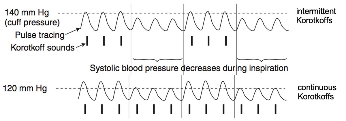 When checking a pulsus paradoxus, don't look for the Korotkoff sounds to "go away with inspiration."

Instead note the difference in SBP between appearance of intermittent (Korotkoff) sounds and appearance of continuous sounds.

That's the pulsus.