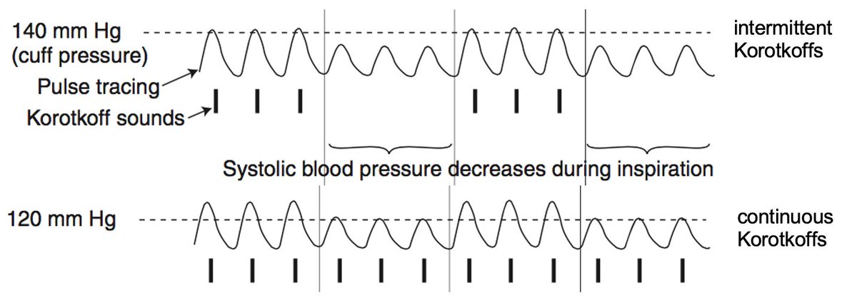 When checking a pulsus paradoxus, don't look for the Korotkoff sounds to 'go away with inspiration.' Instead note the difference in SBP between appearance of intermittent (Korotkoff) sounds and appearance of continuous sounds. That's the pulsus.