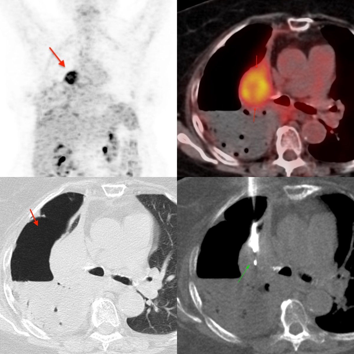 bhavinj's tweet photo. Hydropneumothorax Helping Lung Biopsy. 81 yrs with hydropneumo due to RUL mass & chest tube, for CT biopsy. Uneventful. Enough material for EGFR etc.
If pneumo already present & a chest tube,can go through it & safely biopsy.
#biopsy #ctbiopsy #calung #adenoca #pneumothorax https://t.co/7BDv1za7VY