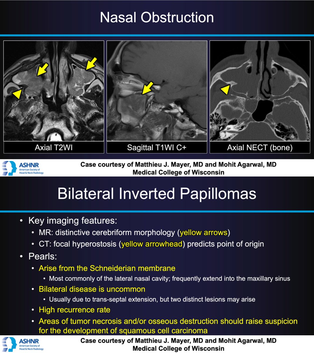 ASHNRSociety's tweet photo. #ASHNRCOTW #129 ANSWER: Bilateral Inverted Papillomas! Thx @radmatthieu &amp; @MohitAgNeurorad @MCWNeurorad 4 case! #ASHNR21 #Ipap

@IlonaSchmalfuss @DShatzkes @CDP_Rad @rhwiggins @nakoontz @cmtomblinson @CincyPedsNeuro @ESHNRSociety @TheASNR @CMGlastonbury @PhilipRChapman1 @RadRupa https://t.co/ZIJQSrANZk