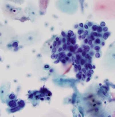 ZMaleki_cyto's tweet photo. High-grade Squamous Intraepithelial Lesion, Pap cytology , #SurePath, Cytopathology #91 #CytoPro @barkanga @PathPro @doc_kartik @ALBoothMD @cytosantos @britishcytology @IACytology @SintawatWang @IvanaKholova @mdlozanoe @MauroSaieg @tlabiano @NayarRitu @PatMcIntireMD https://t.co/RwDp08JbD1