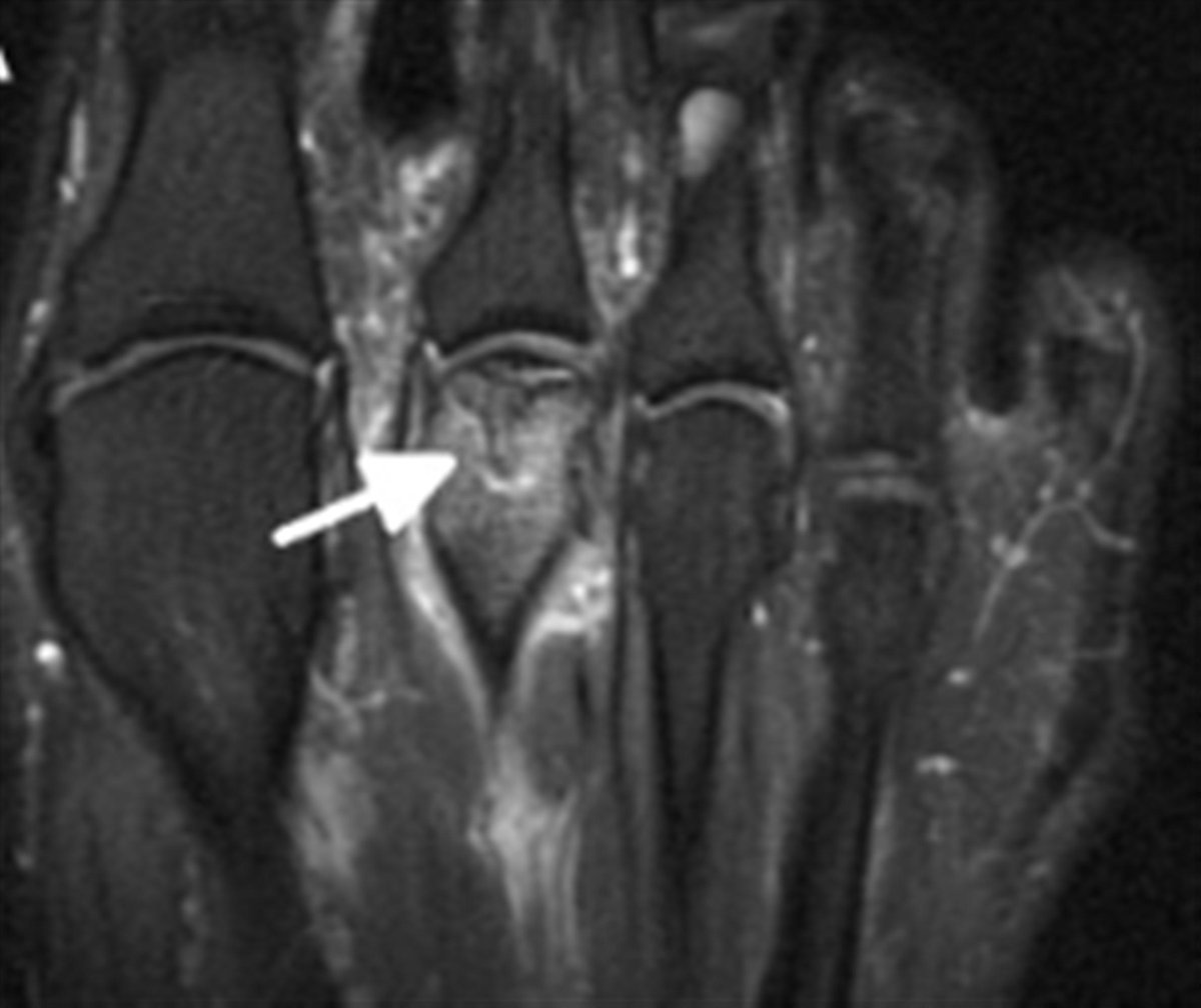Freiberg's disease is characterized by infarction &amp; fracture of the metatarsal head. It's thought to be related to blood supply disruption due to microtrauma or osteonecrosis &amp; stress overloading leading to eventual collapse of 2nd MT head. Learn more: anchor.fm/orthobullets/e…