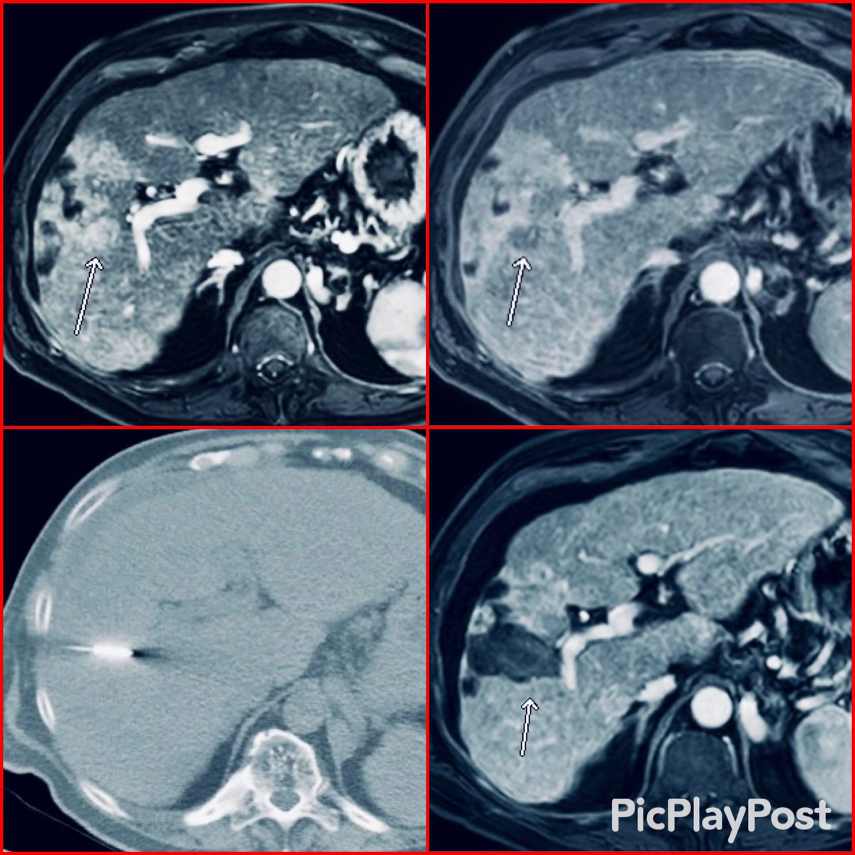 EinsteinIR's tweet photo. “It won’t be sunny anymore in Philly for this cancer”

Follow-up CT 6mths after MWA. LR:TR Nonviable. 

Another one bites the dust #Irad

🙌🏻💥 @iRadRock @BalaNatarajanIR 💥🙌🏻

#CancerSnipers #CancerFree @SIRRFS @SIRspecialists @SIR_ECS https://t.co/mVzlwPmCLi