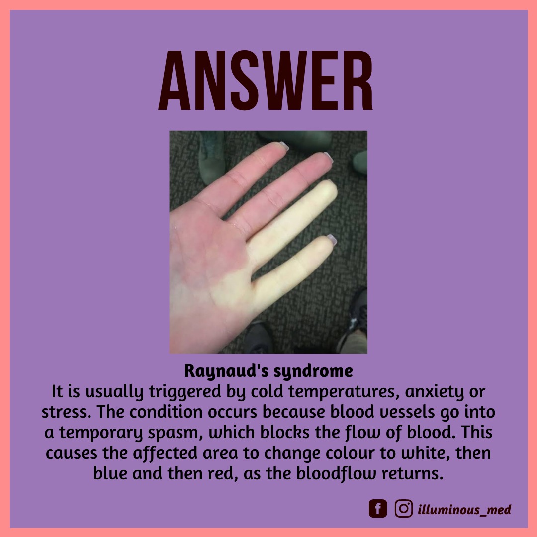 ANSWER 
#Dailyquestionseries
Hope you enjoyed the question!
Comments are open to discussion. Send in your doubts in the comments!
.
.
#Illuminous
#FOAMed
.
.
.
.
.
.
.
#medicine  #medicalquiz #medschoollife #plab #mbbsquestion #healthcare #mbbs #medicalnotes #MedTwitter