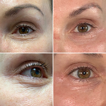 damowanggg's tweet photo. Plasma pen 
#Eyelid ptosis, #baggyskin , #darkcircles under eyes #Wrinkles 
#Pigment #agespots #epidermis #freckles
#Acne #postacne #scars #cicatrixes
#Seborrhea #angioma #seborrheawarts #stellate #hemangioma
Certificate: CE approved
☎️Whatsapp:0086 15503022871 https://t.co/y8eWFrGe79