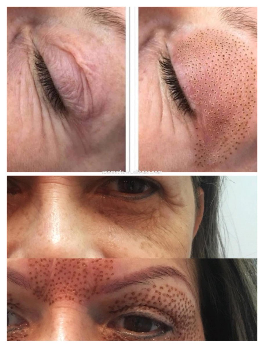 damowanggg's tweet photo. Plasma pen 
#Eyelid ptosis, #baggyskin , #darkcircles under eyes #Wrinkles 
#Pigment #agespots #epidermis #freckles
#Acne #postacne #scars #cicatrixes
#Seborrhea #angioma #seborrheawarts #stellate #hemangioma
Certificate: CE approved
☎️Whatsapp:0086 15503022871 https://t.co/y8eWFrGe79