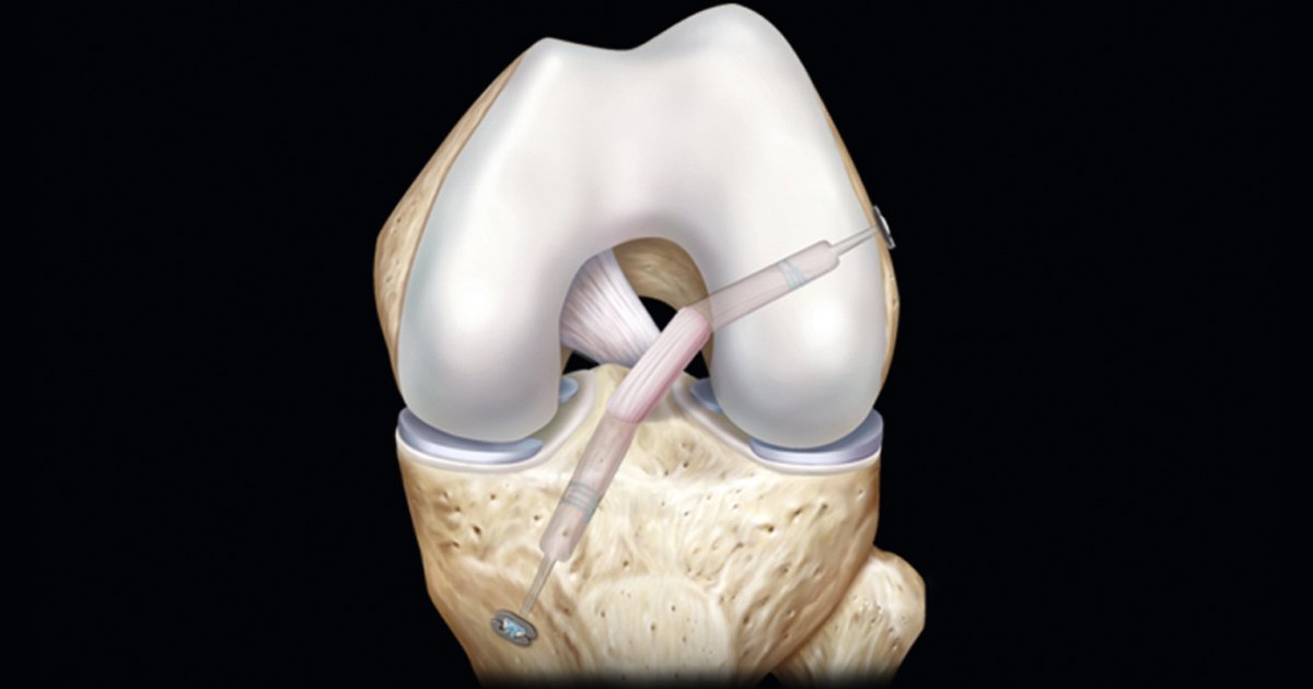 ArthrexUK's tweet photo. GraftLink® Technique. Combining the latest #arthrexinnovation and #evidence based practice.
#graftlink #ACLrecon #arthroscopy #sportssurgery
More info here: https://t.co/jToXMcNhoj https://t.co/QjmLrrTJaK