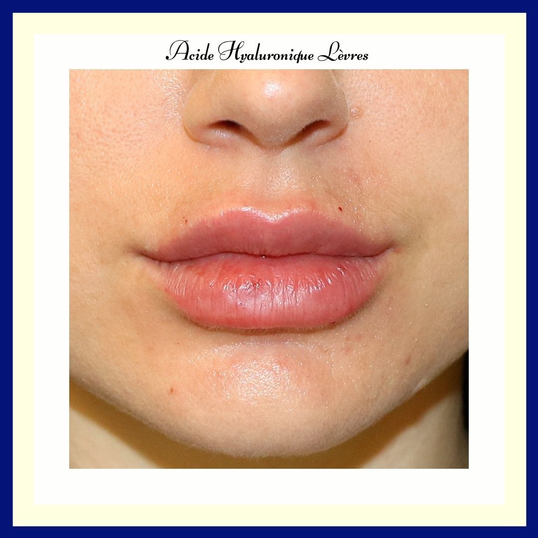 DocteurDeRunz's tweet photo. 💋INJECTION DES LEVRES 💋💉
L' #acidehyaluronique permet d'apporter de redonner du galbe à des lèvres et les rendre plus charnues. ⠀

#AH #injections #injection #metz #lorraine #esthetique  #luxembourg #hyaluronicacid #levres #lip  #femme #feministe #feminite #levres https://t.co/usn9cR3wGf