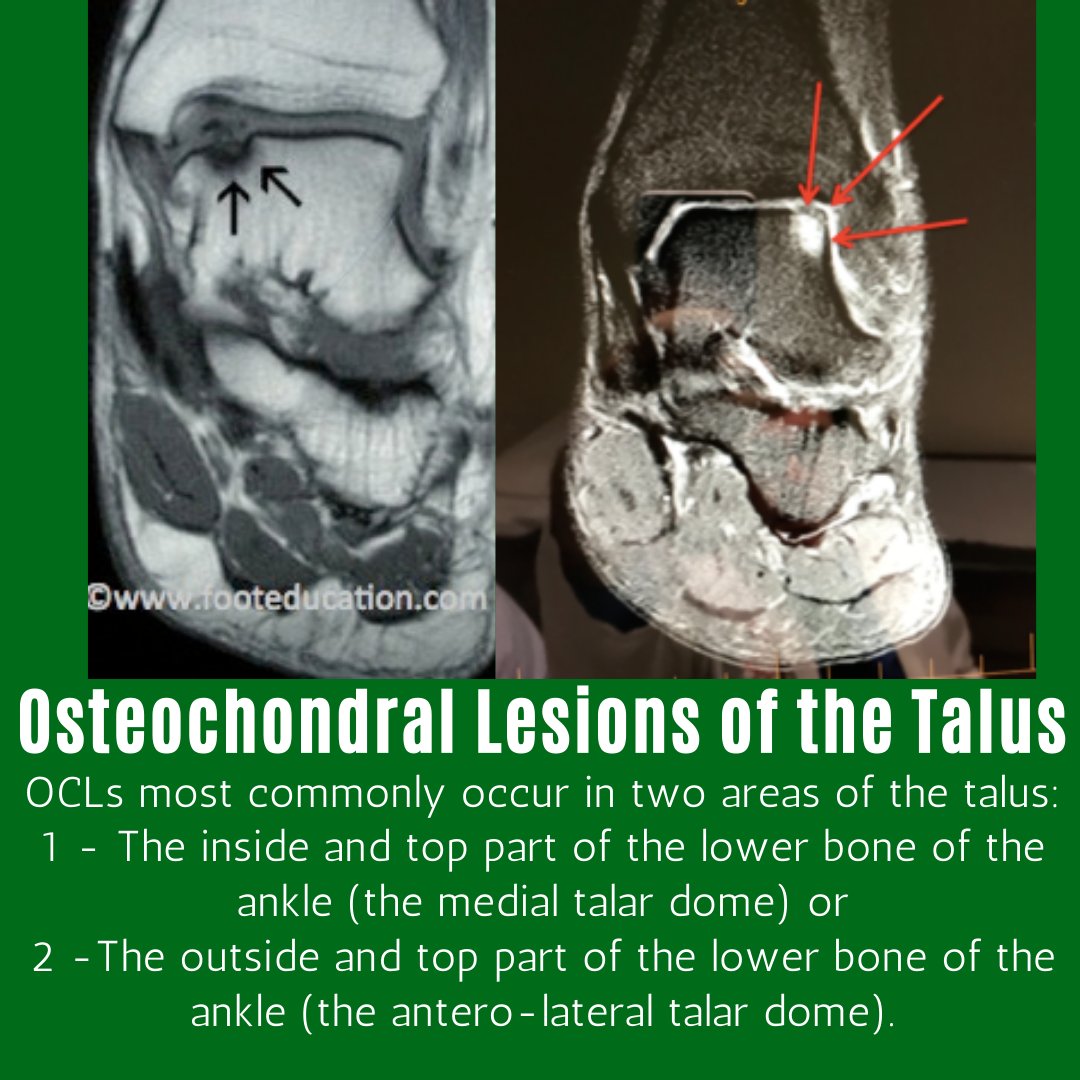 An osteochondral lesion of the talus (OLT) is an area of abnormal, damaged cartilage and bone on the top of the talus bone (the lower bone of the ankle joint).  buff.ly/3pA9kvz