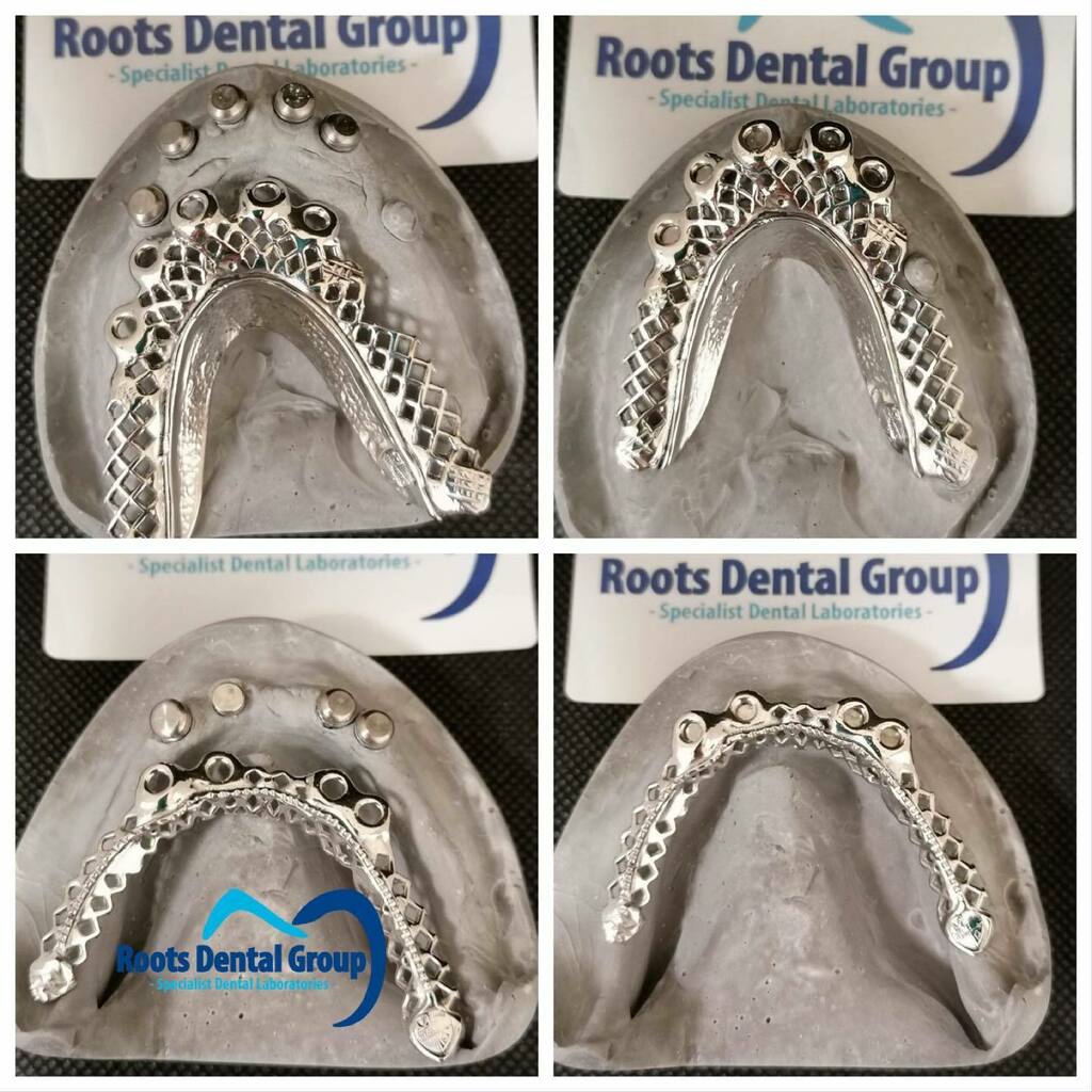 rootsdental's tweet photo. Beauty of a chrome attachment case , HAND crafted in our lab , happy happy dentist. PM for details #dentist #dentallab #dentallaboratory #privatedentist #dentistry #digitaldentistry #dentaltech #dentaltechnology #dentaltechnician #dentaltechnicians #dentistlife #teeth #smile… https://t.co/cFr1XMubVN